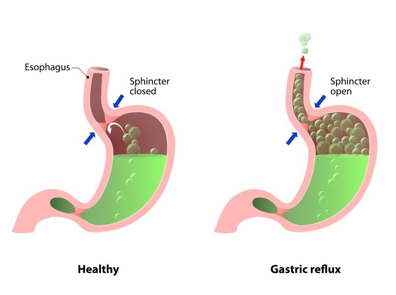 How to Avoid Acid Reflux this Christmas - Christ Church Cranbrook ...