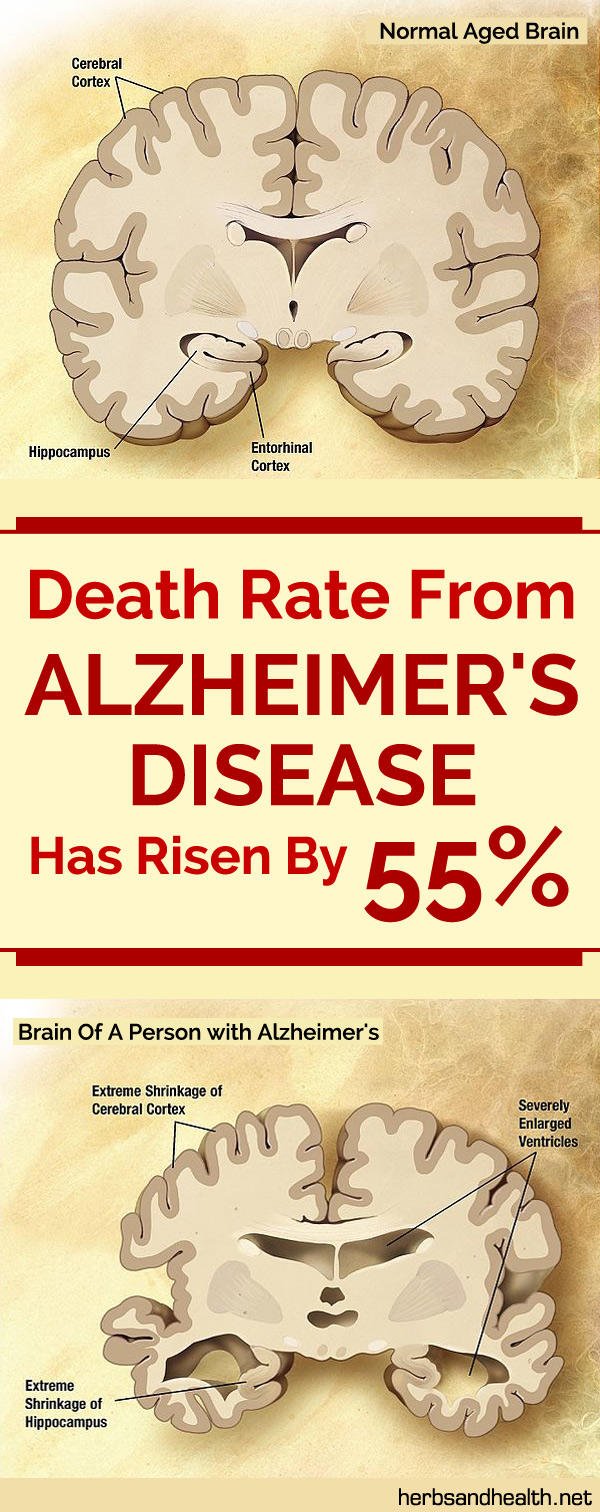 Death Rate From Alzheimer’s Disease Has Risen By 55%