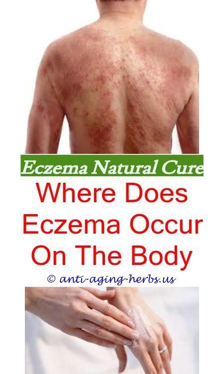 What is Eczema?