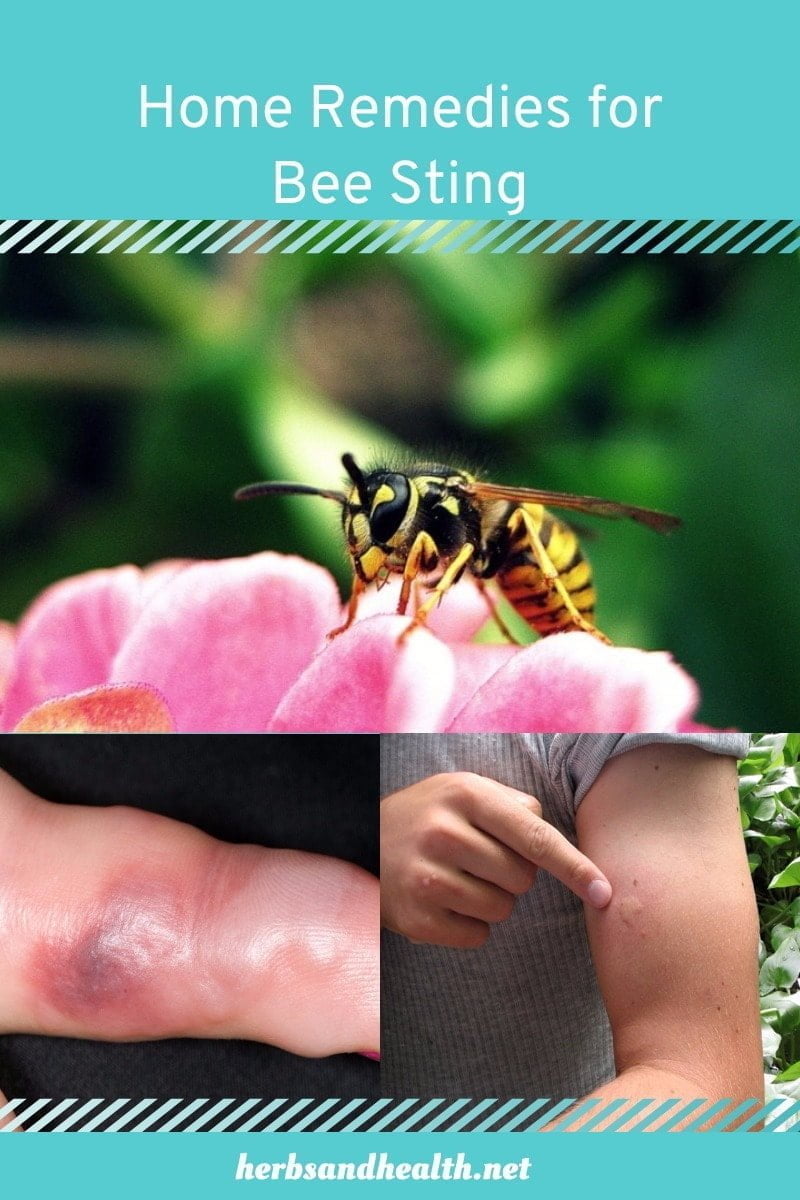 Bee Sting (and Other Insect Bites)