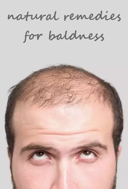 Baldness