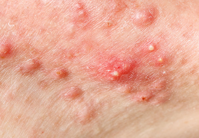 Do Home Remedies for Cystic Acne Work? – Health Essentials from Cleveland Clinic