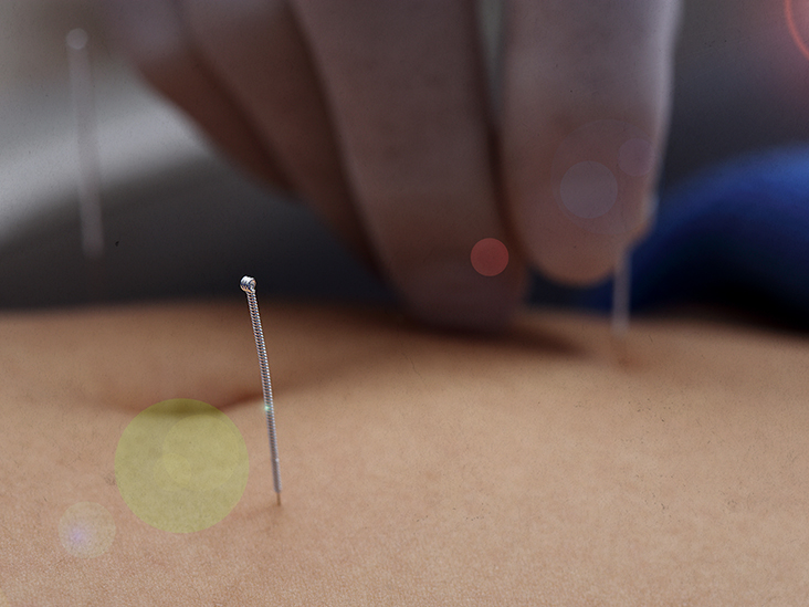 Acupuncture for IBS: Efficacy and alternative treatment options – Medical News Today