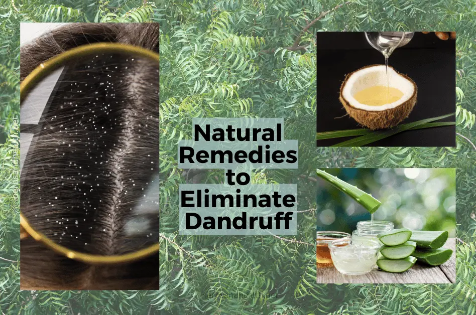 Dandruff woes taking a toll on you? Follow these natural remedies to eliminate it