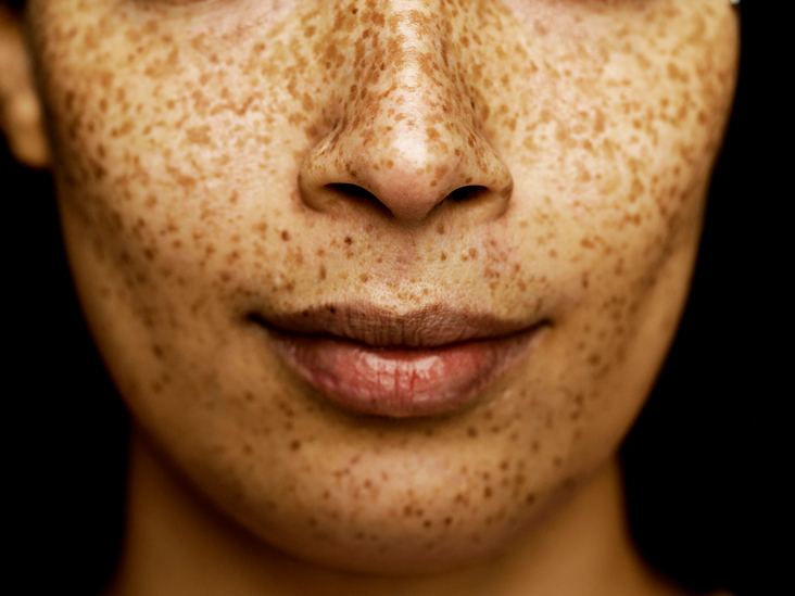 Chemical peels for freckles: Results, risks, costs, and more – Medical News Today