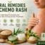 Natural Remedies for Chemo Rash: Safe Ways to Soothe Skin During Cancer Treatment